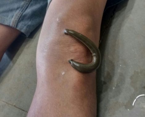 leech therapy